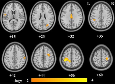 Brain Structures Associated with Internet Addiction Tendency in Adolescent Online Game Players